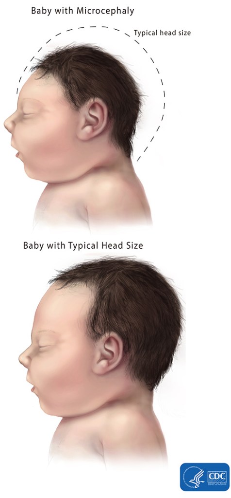 microcephaly-comparison-500px1